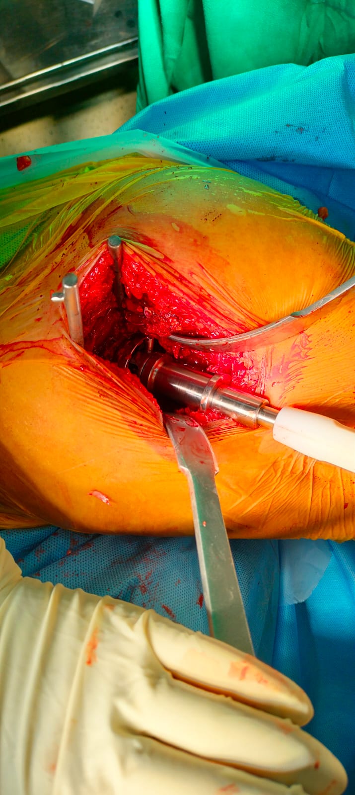 Ligament Surgeon in Patna- Olive Hospital - Dr Kumar Gaurav